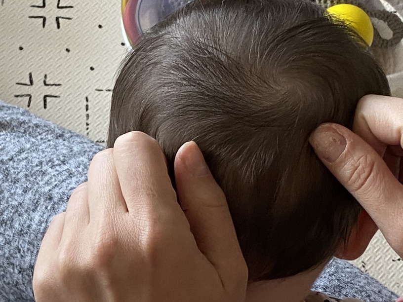 Manhattan, New York Head lice treatment & Mobile (inhome) removal